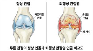무릎 관절의 정상 연골과 퇴행성 관절염 연골 비교도